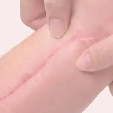 Närbild av händer som varsamt behandlar ett ärr på huden.